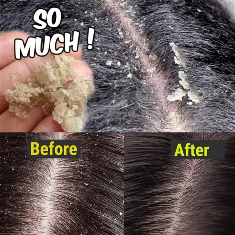 Fast Anti Dandruff Hair Treatm - Castor Oil Soap 评论和价格